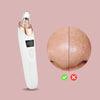 Last Day 50% OFF | PoreGlow™ Blackhead Remover
