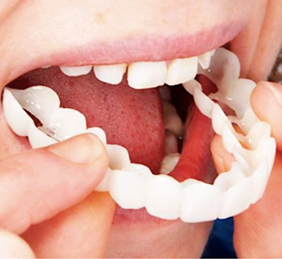 PerfectSmile™️ Snap-on teeth (upper + lower kit)