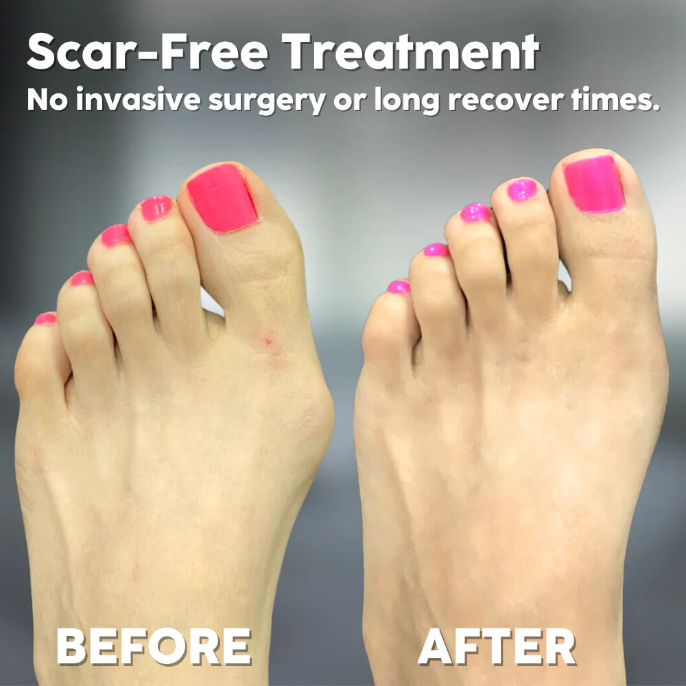 Last Day 50% OFF | ToeAlign™ Corrector for Hallux Valgus